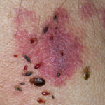 bedbug-bites-look-like