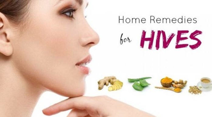 How to Treat Hives Permanently Naturally at Home permanently-naturally-at-ho