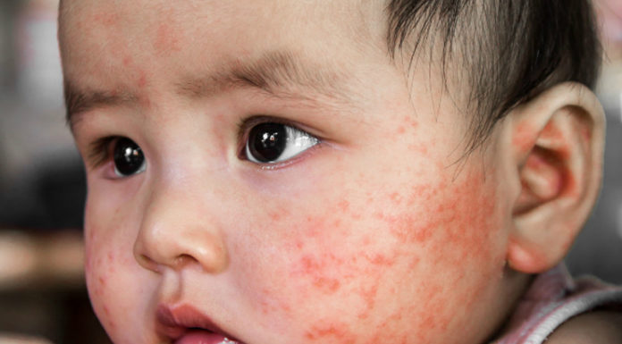 Summer-rashes-in-babies